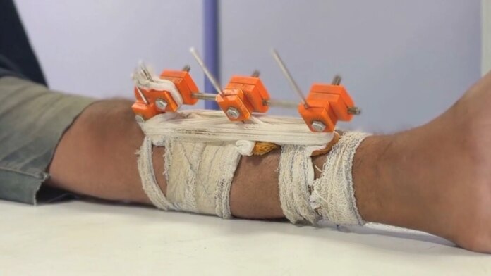 Gaza doctors use 3D tech to save limbs shattered by Israel from amputation | Israel-Palestine conflict News